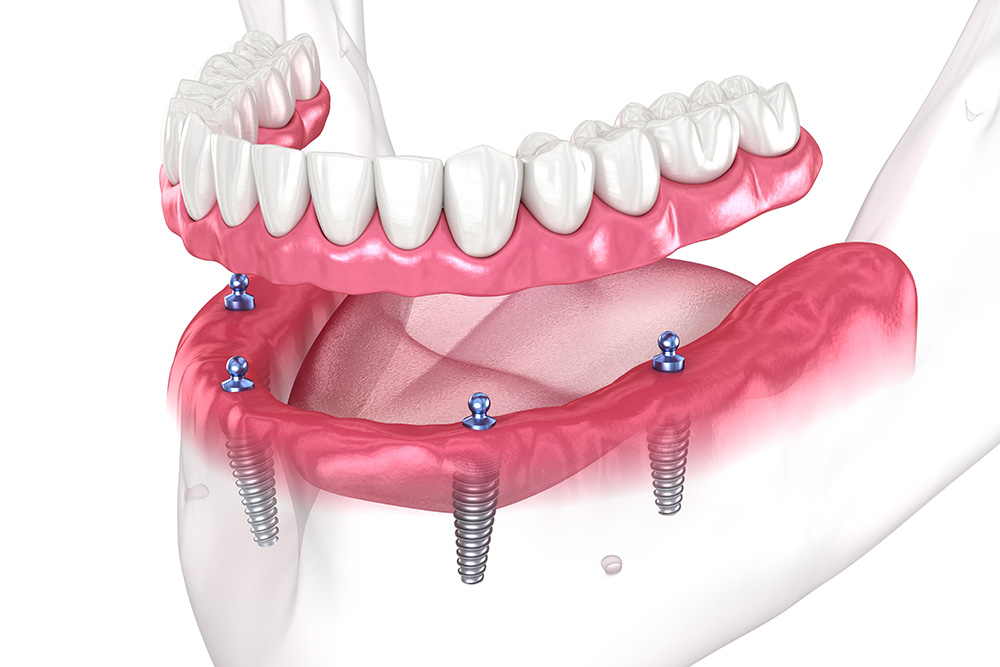 Implantacija ir laikinas dantis