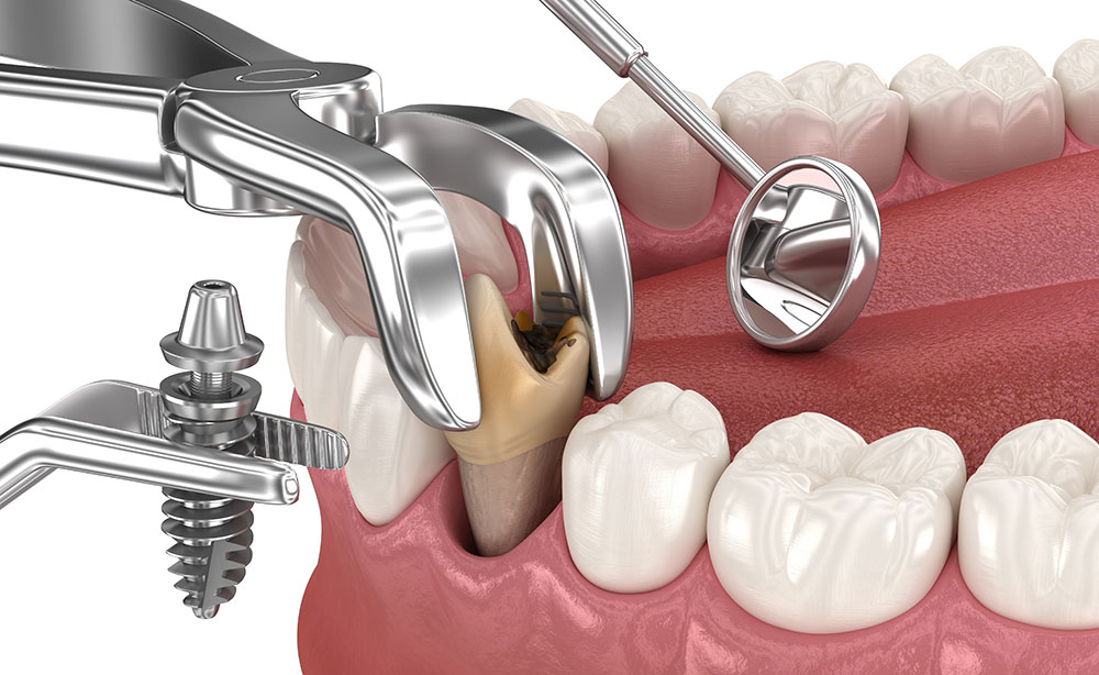 Implantacija ir laikinas dantis